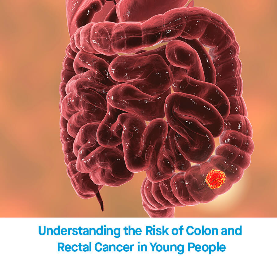 Understanding the Risk of Colon and Rectal Cancer in Young People