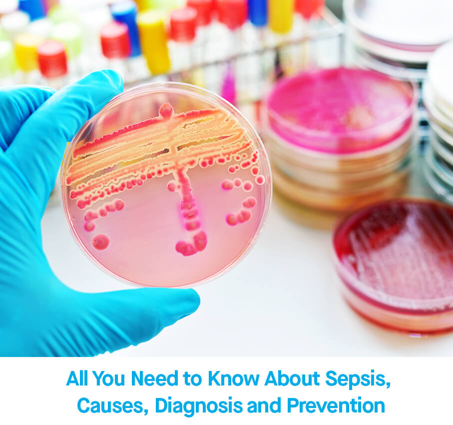All You Need to Know About Sepsis: Causes, Diagnosis and Prevention